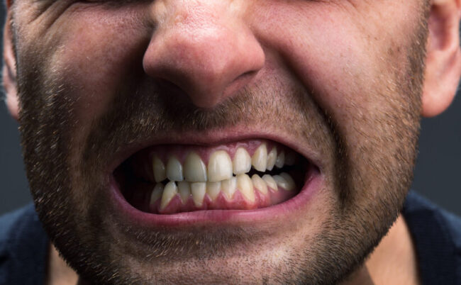 Diagnoses And Treat Bruxism